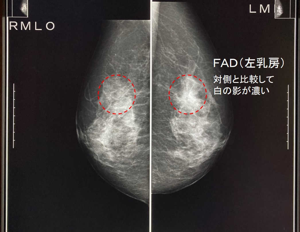 免疫療法にはどのような副作用がありますか?